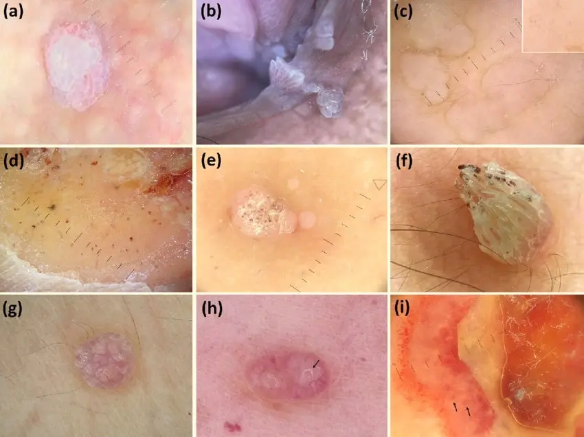 تشخیص زگیل تناسلی و hpv srcset=